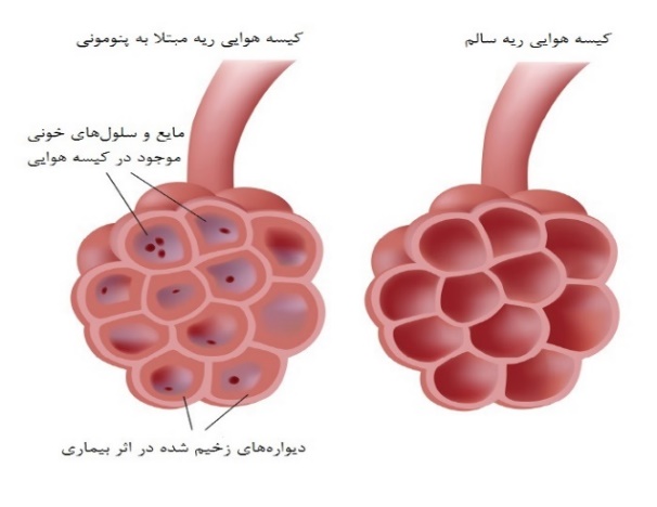 پنوموني ويروسي